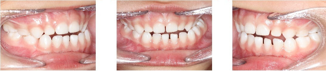 Crossbite: Occurs when the upper and lower teeth do not align correctly.