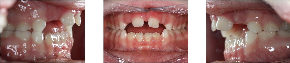 Open Bite: Lack of contact in the anterior region of the dental arches.