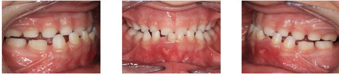 Underbite: Happens when lower teeth overlap the upper teeth.