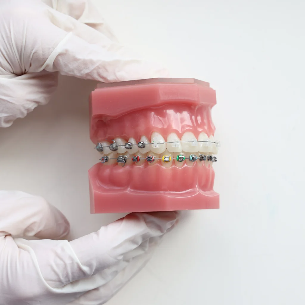 Braces