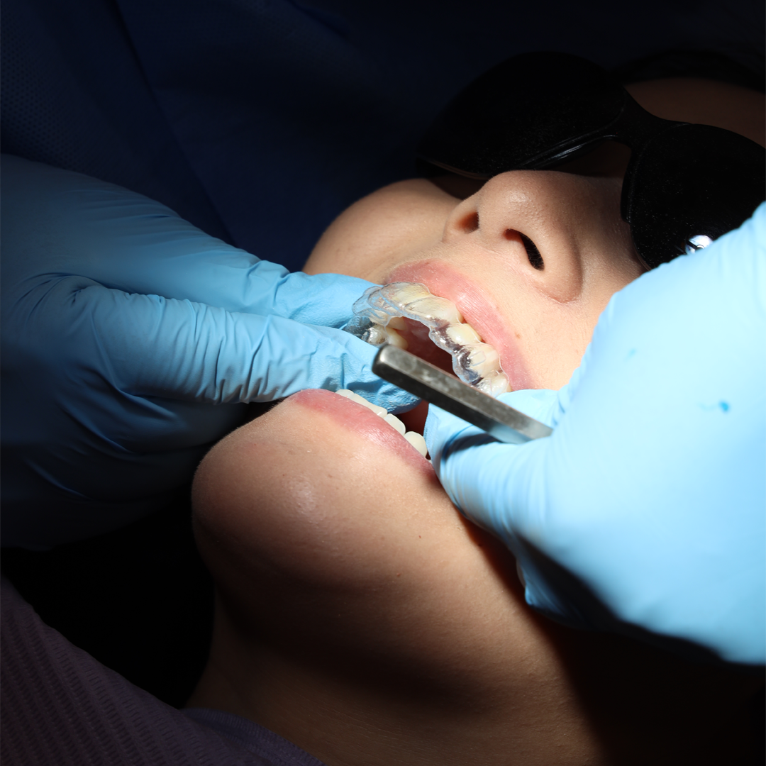 Invisalign 1