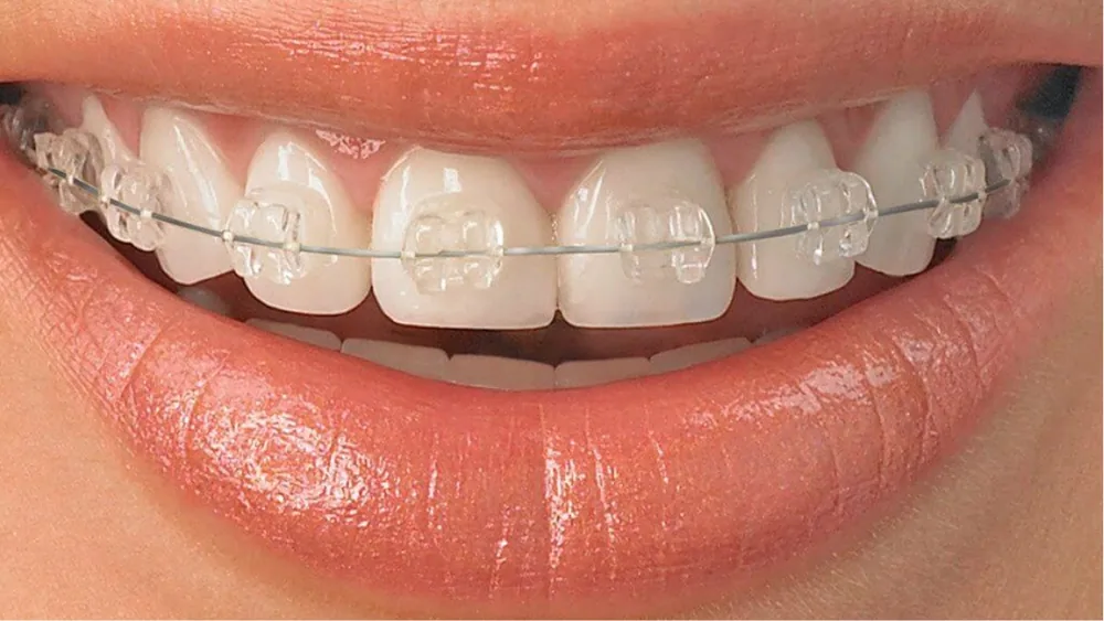 Smile with clear ceramic braces on the upper teeth