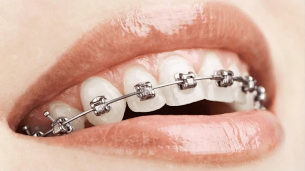 Close-up of self-ligating metal braces on the upper teeth