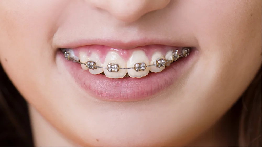 Smiling patient wearing traditional metal braces