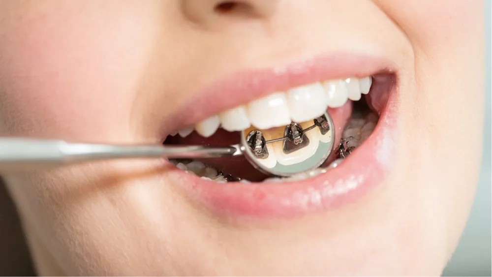 Dental mirror showing lingual braces fitted to the back of the teeth